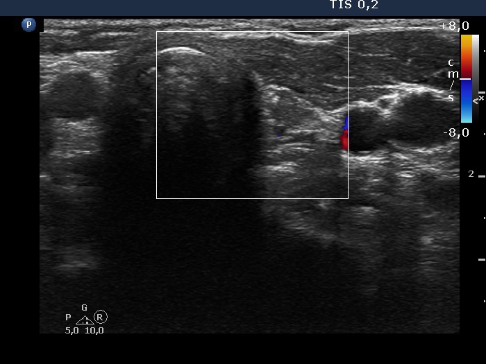Right lobe, longitudinal scan