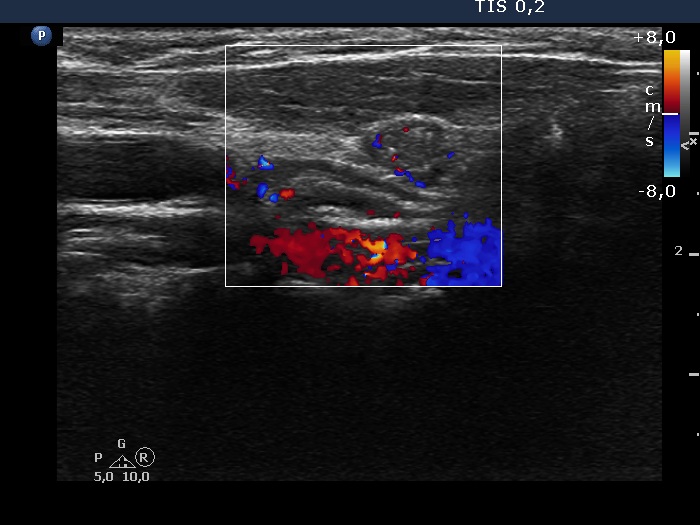 Right lobe, longitudinal scan
