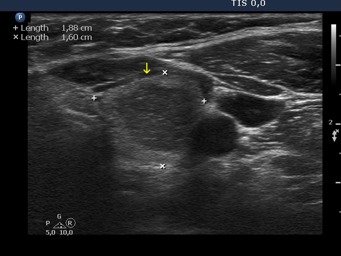 Right lobe, longitudinal scan