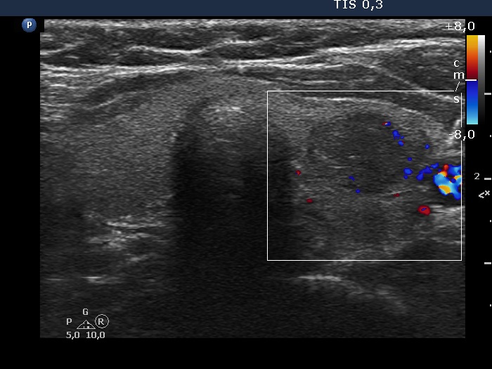 Right lobe, longitudinal scan