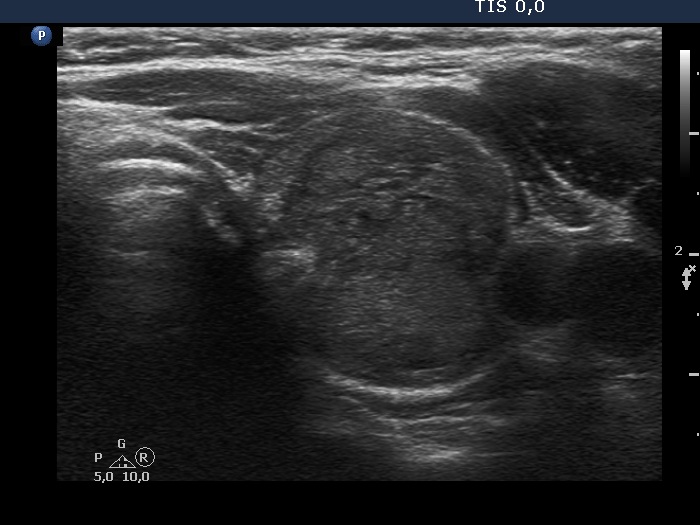Right lobe, longitudinal scan