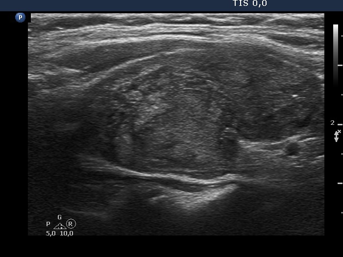 Right lobe, longitudinal scan