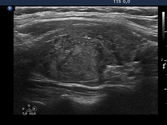 Right lobe, longitudinal scan