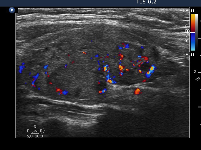 Right lobe, longitudinal scan