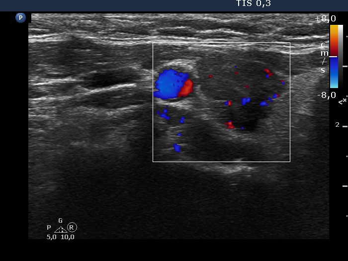 Right lobe, longitudinal scan