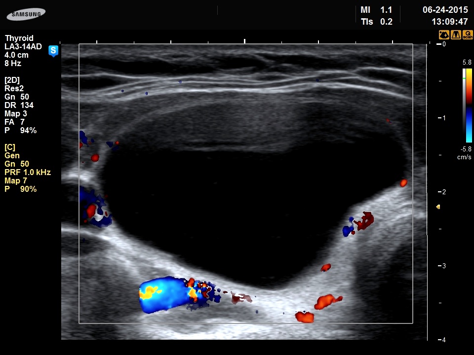 Right lobe, longitudinal scan