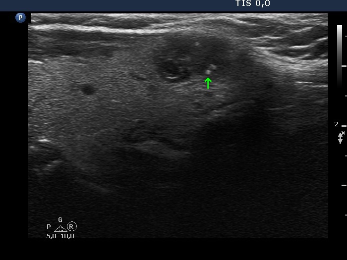 Right lobe, longitudinal scan