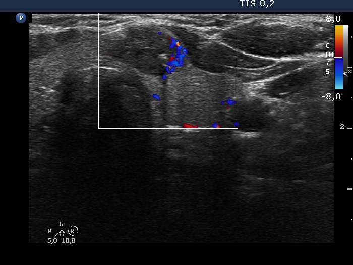 Right lobe, longitudinal scan