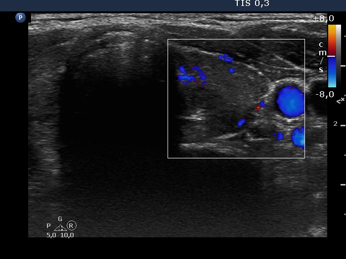 Right lobe, longitudinal scan