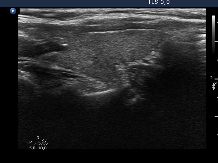 Right lobe, longitudinal scan