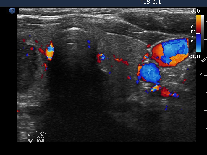 Right lobe, longitudinal scan