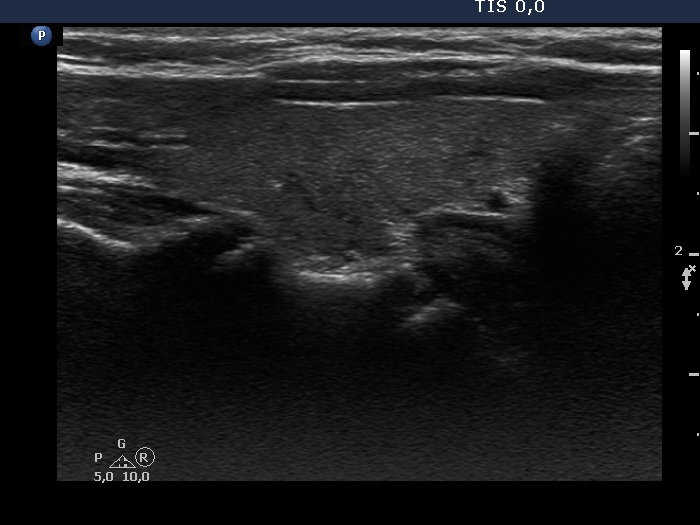 Right lobe, longitudinal scan