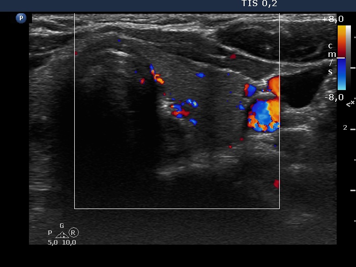 Right lobe, longitudinal scan