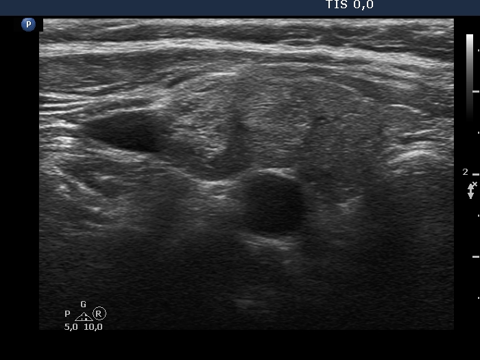 Right lobe, longitudinal scan