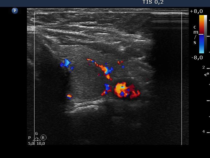 Right lobe, longitudinal scan