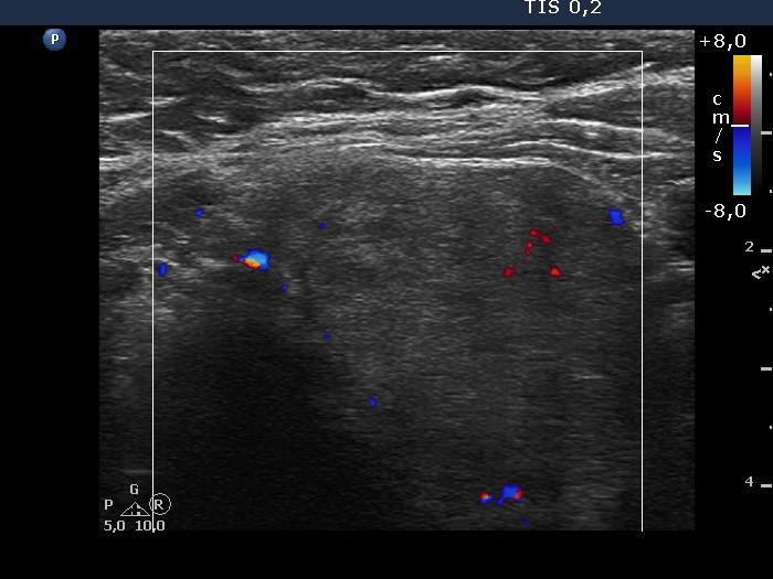 Right lobe, longitudinal scan