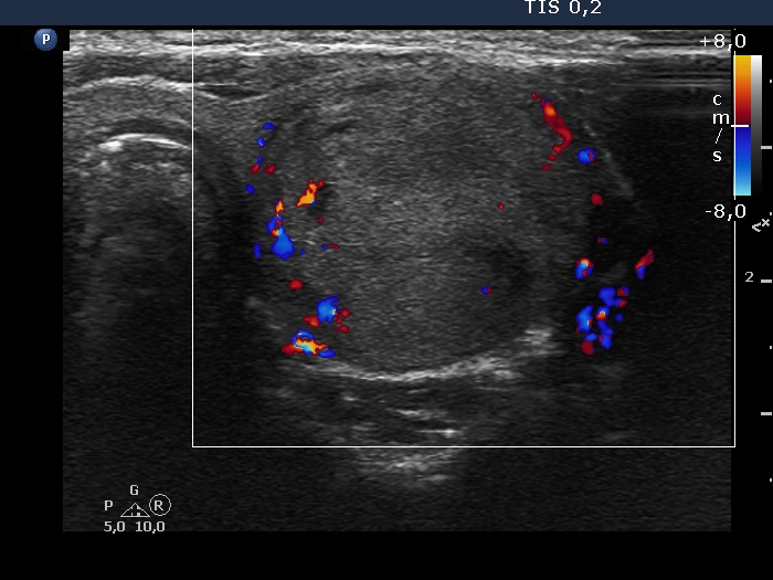 Right lobe, longitudinal scan