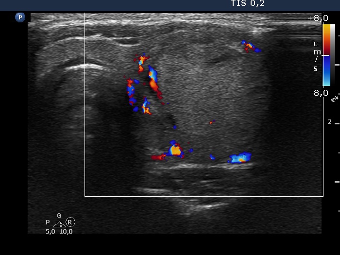 Right lobe, longitudinal scan