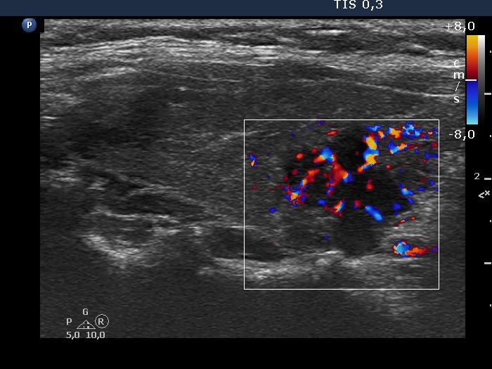 Right lobe, longitudinal scan