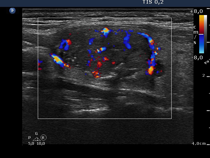 Right lobe, longitudinal scan