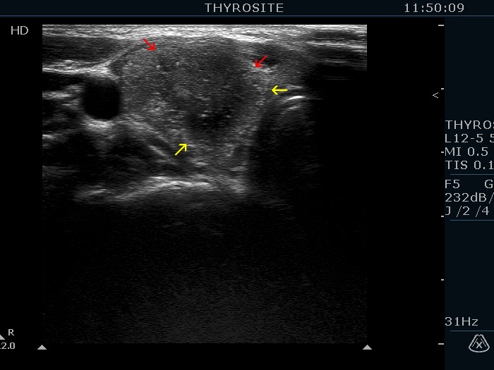 Right lobe, longitudinal scan
