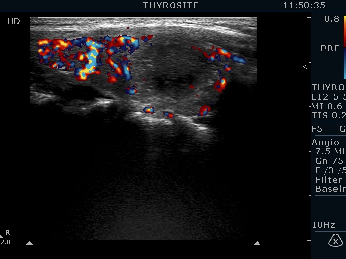 Right lobe, longitudinal scan