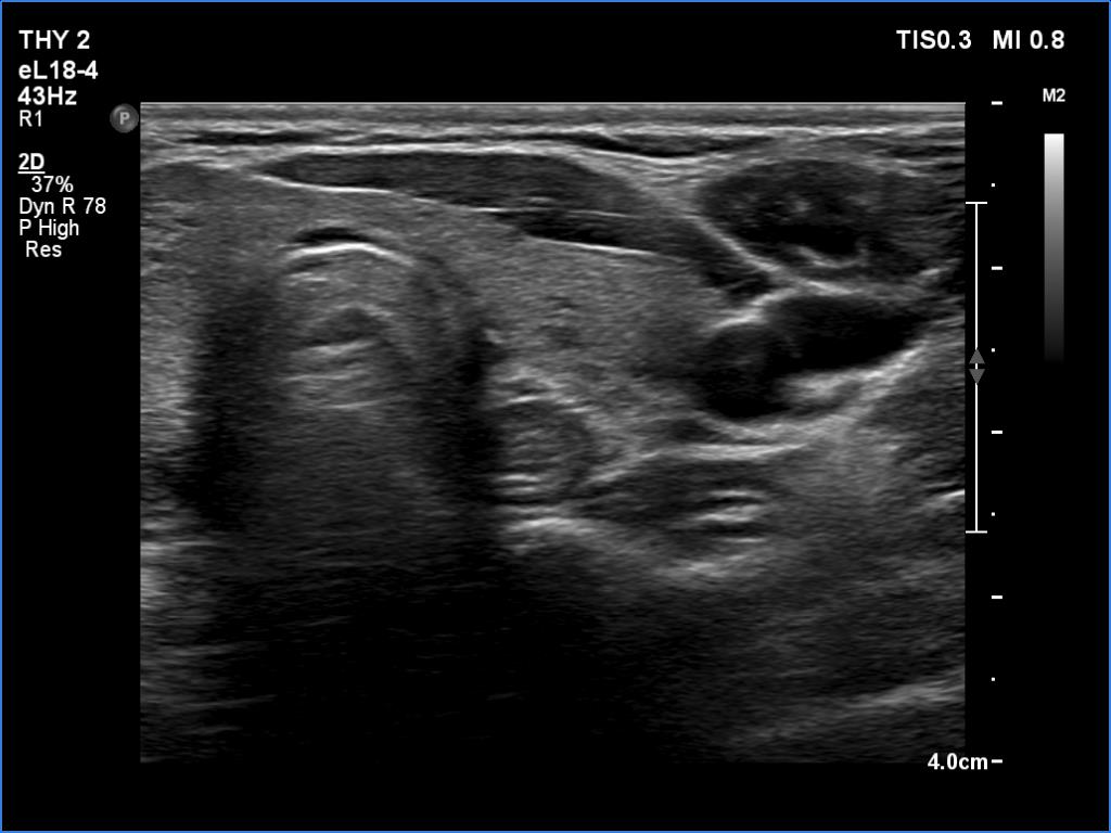 Right lobe, longitudinal scan