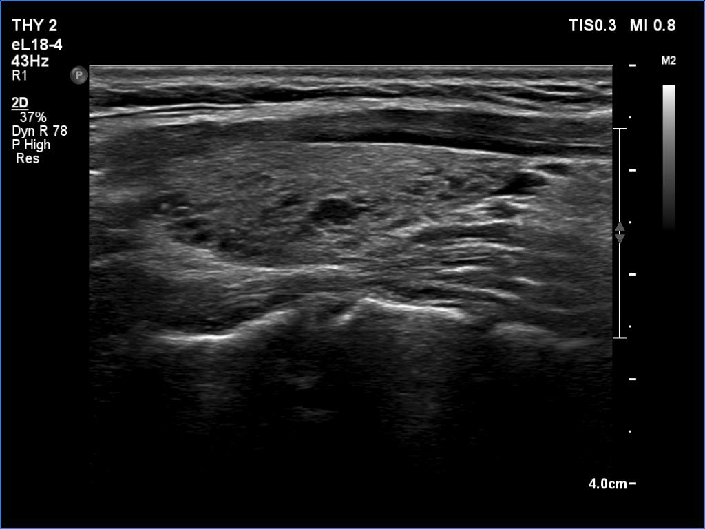 Right lobe, longitudinal scan
