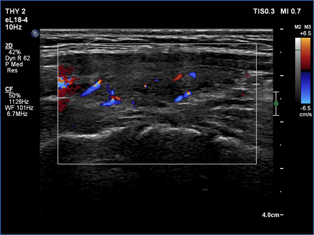 Right lobe, longitudinal scan