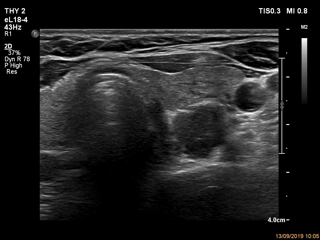 Right lobe, longitudinal scan