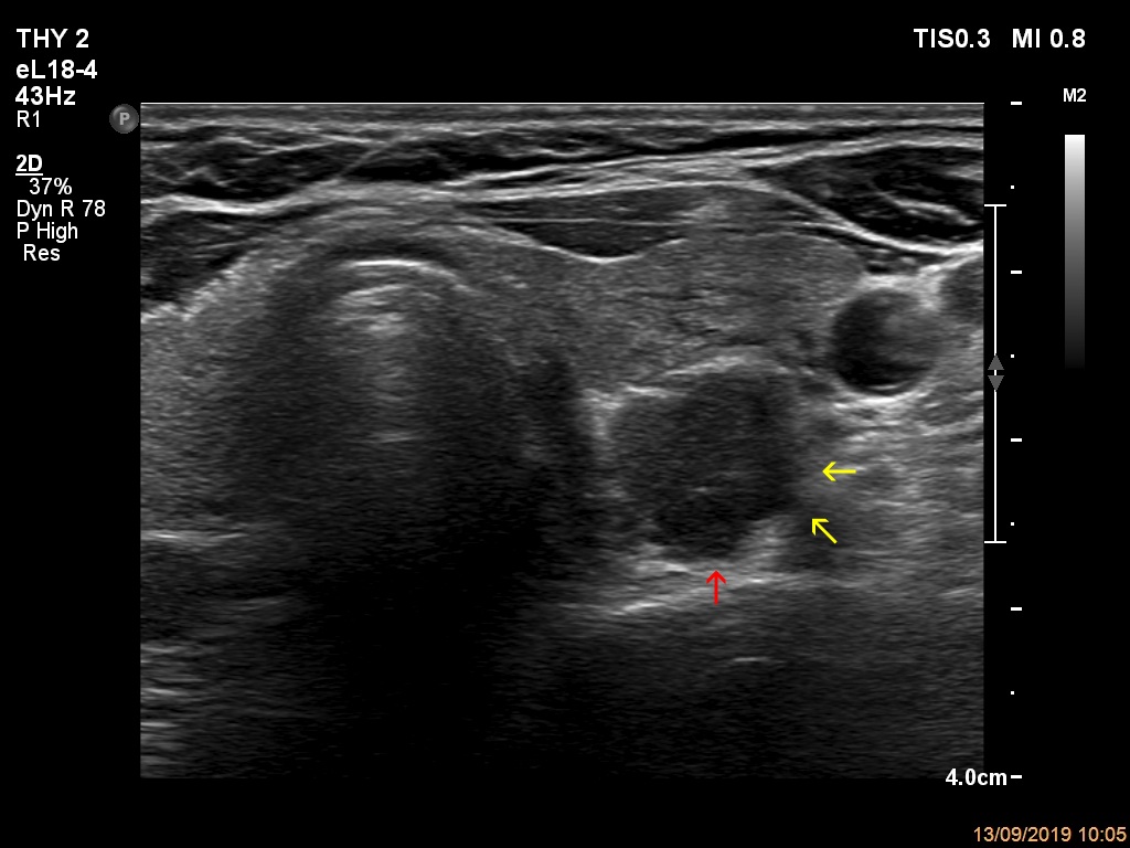 Right lobe, longitudinal scan