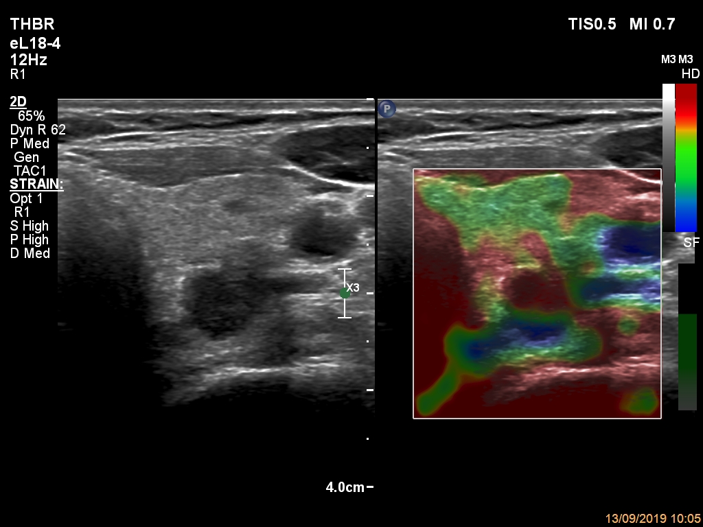 Right lobe, longitudinal scan