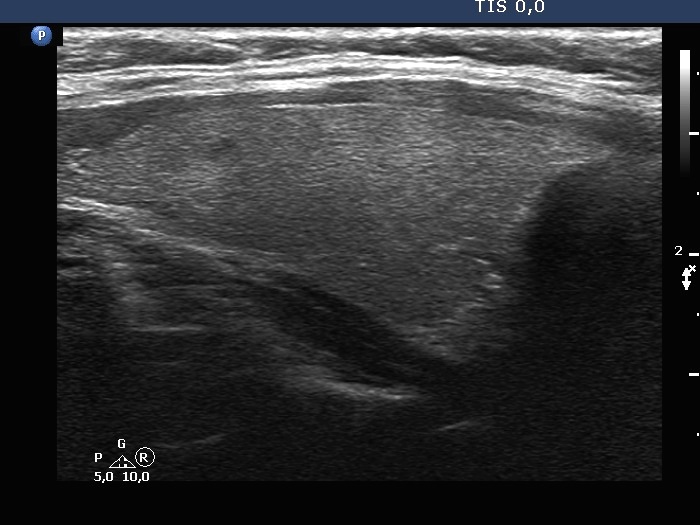 Right lobe, longitudinal scan