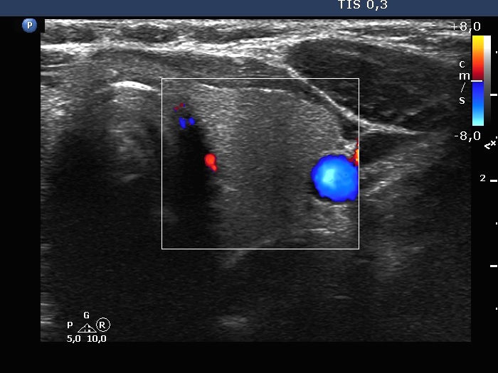 Right lobe, longitudinal scan