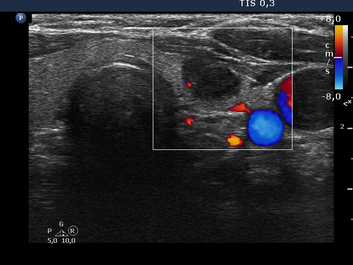 Right lobe, longitudinal scan