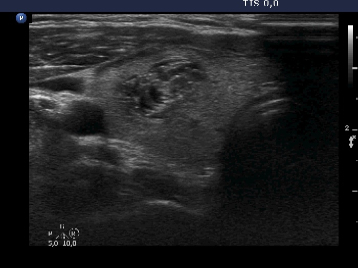 Right lobe, longitudinal scan