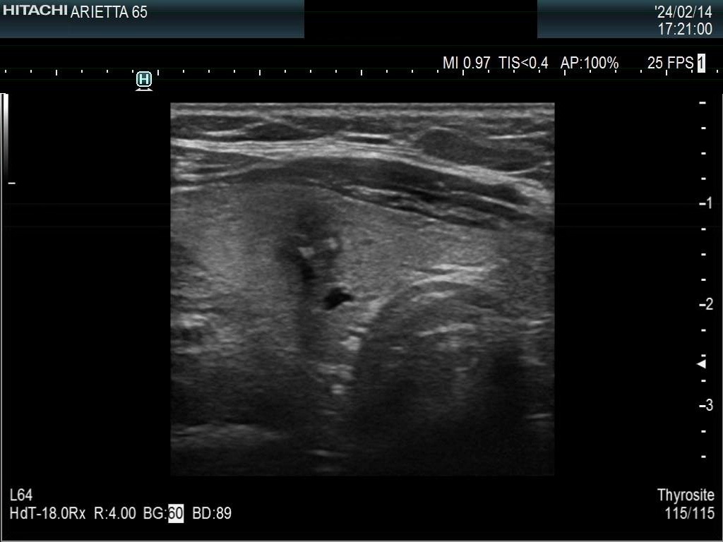 Right lobe, longitudinal scan
