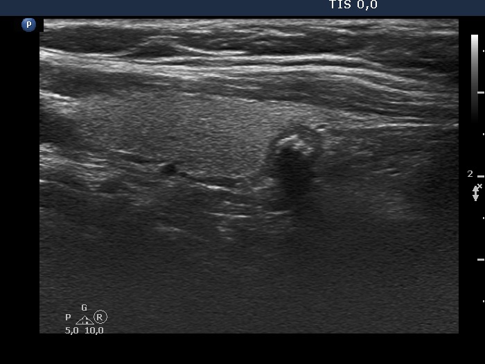 Right lobe, longitudinal scan