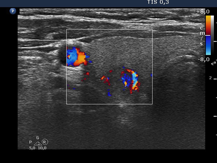 Right lobe, longitudinal scan