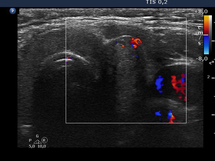 Right lobe, longitudinal scan