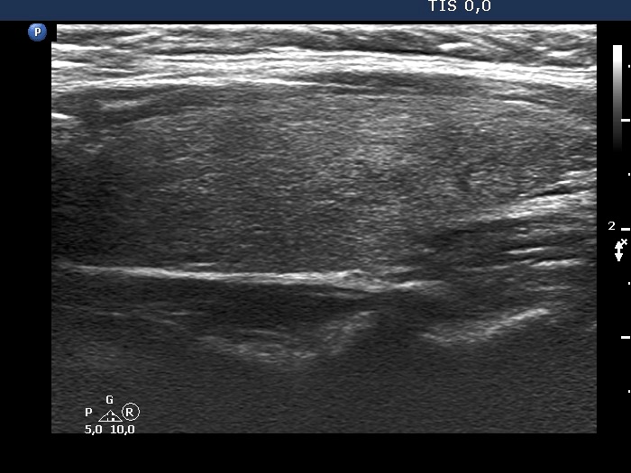 Right lobe, longitudinal scan