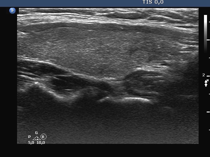Right lobe, longitudinal scan