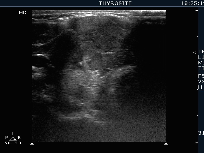 Right lobe, longitudinal scan