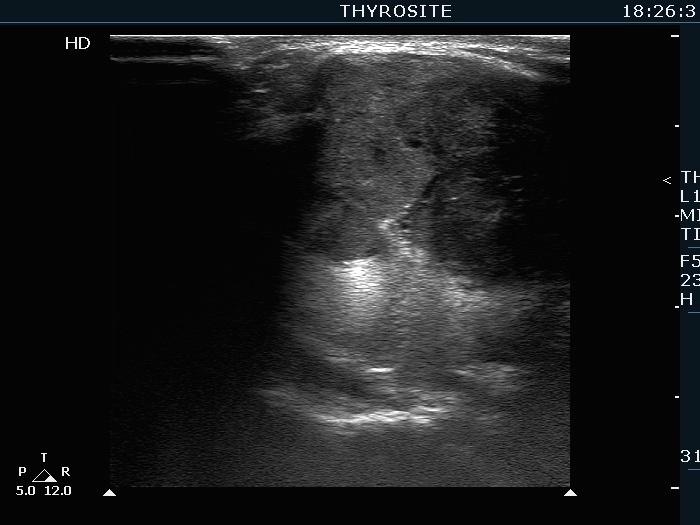 Right lobe, longitudinal scan