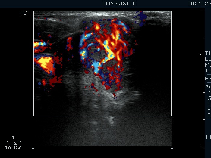 Right lobe, longitudinal scan