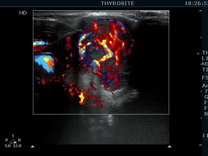 Right lobe, longitudinal scan