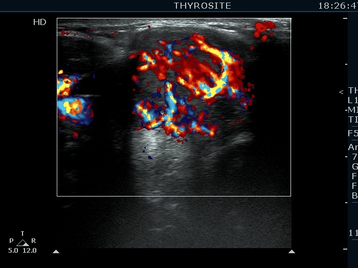 Right lobe, longitudinal scan