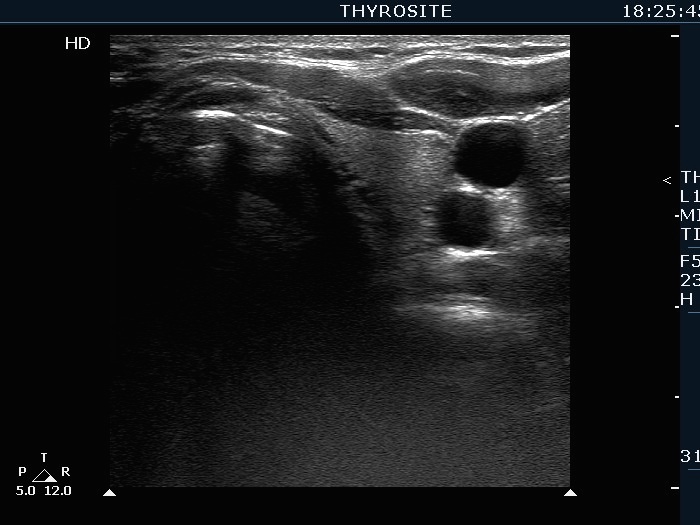 Right lobe, longitudinal scan
