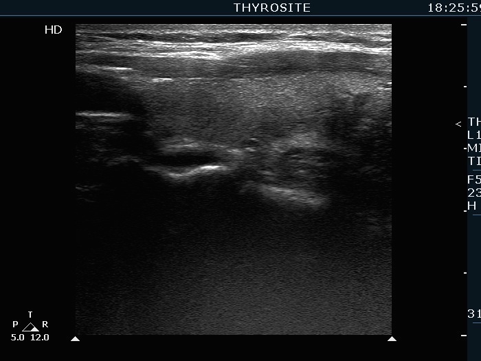 Right lobe, longitudinal scan