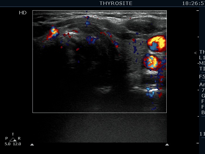 Right lobe, longitudinal scan